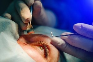 cirurgia, catarata, oftalmo, glaucoma