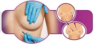 Prótese de silicone precisa mesmo ser trocada a cada 10 anos? Especialista esclarece mito 
