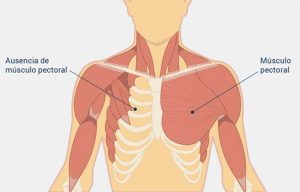 Síndrome de Poland: cirurgia plástica devolve simetria e autoestima a pacientes com anomalia congênita rara